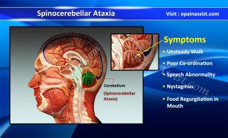 Spinocerebellar-Ataxia